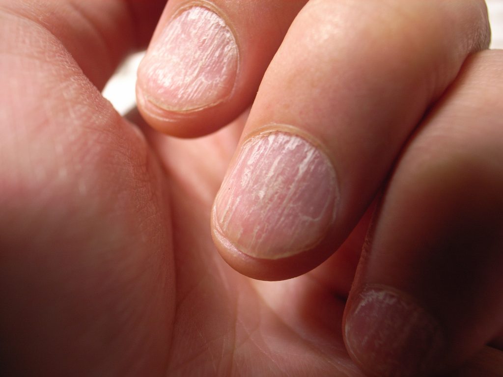 Was Rillen in den Fingernägeln über die Gesundheit verraten - AOZ